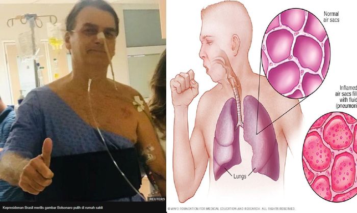 Presiden Brazil menderita pneumonia