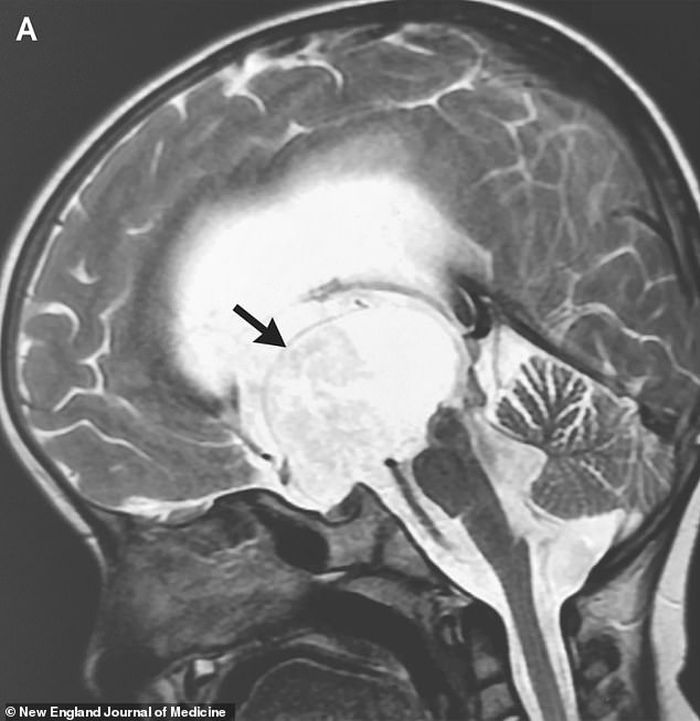 Ada Kista Setelah Keguguran