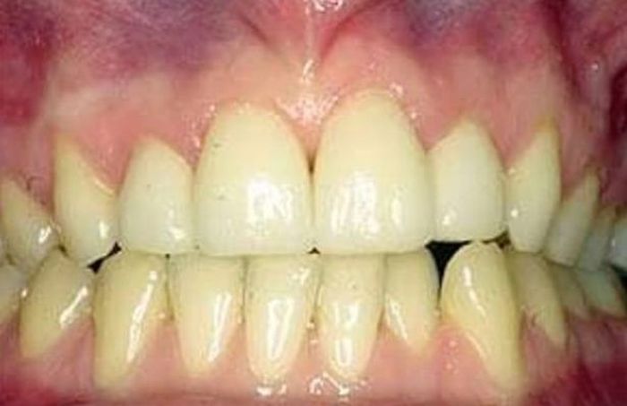 


Gigi-gigi ini kondisinya sehat (meskipun warnanya kuning) karena gusinya berwarna merah muda terang