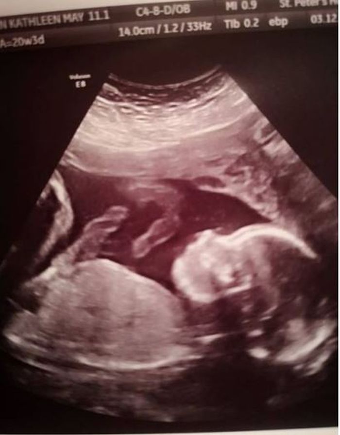 Bayi 24 Minggu Dikeluarkan dari Janin, Kemudian Dimasukkan Kembali ke