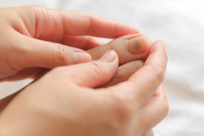 Garis gelap pada kuku Anda mungkin melanoma