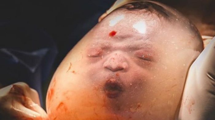 Viral Foto Bayi Lahir dengan Kondisi Masih di Dalam Kantung Ketuban, Wajahnya Terlihat Jelas ...
