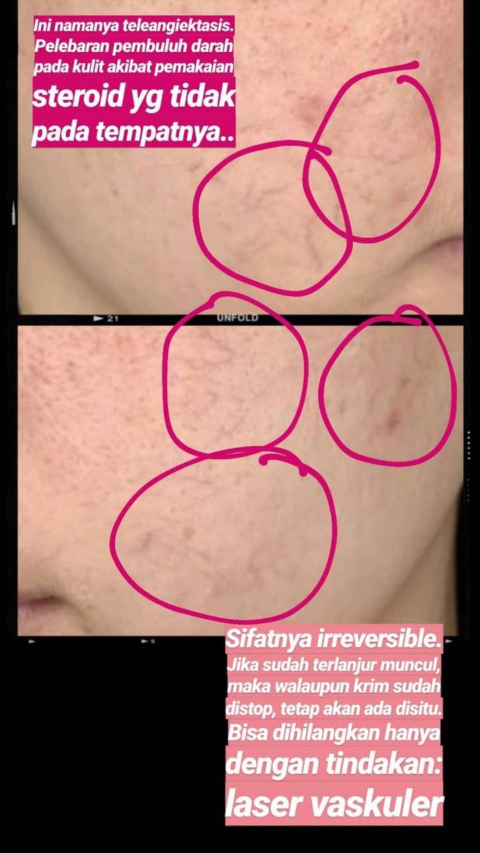 Heboh Diduga Karena Losion Pemutih Badan Palsu Tubuh Wanita Ini Penuh Cakaran Menyerupai Stretch Mark Semua Halaman Stylo