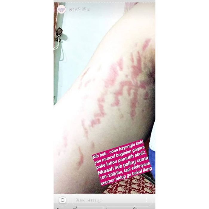 Gurat yang timbul akibat pemakaian krim steroid.