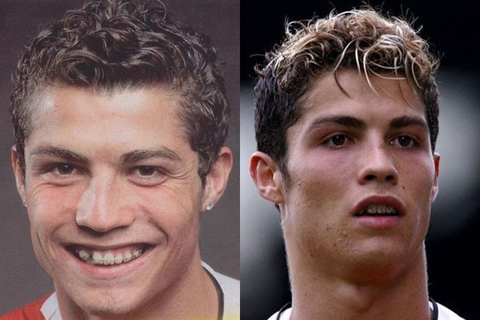 Cristiano Ronaldo memakai behel untuk meratakan giginya biar semakin hits dan tampan
