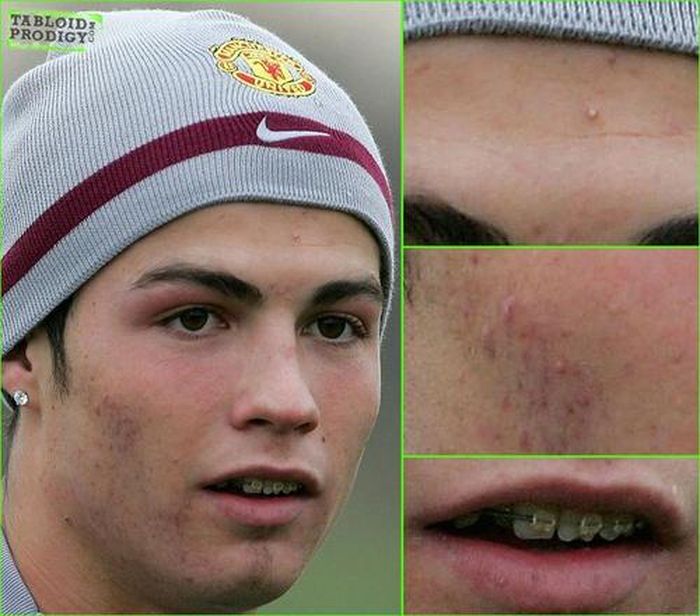 Cristiano Ronaldo ketika belum memperhatikan penampilan,  masih banyak jerawat di mukanya dan masih mengenakan kawat gigi