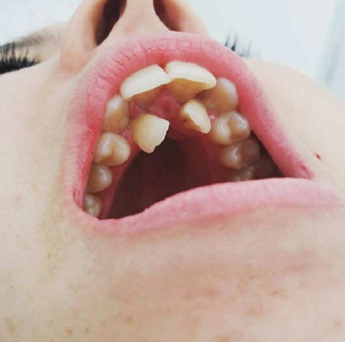 Hyperdontia