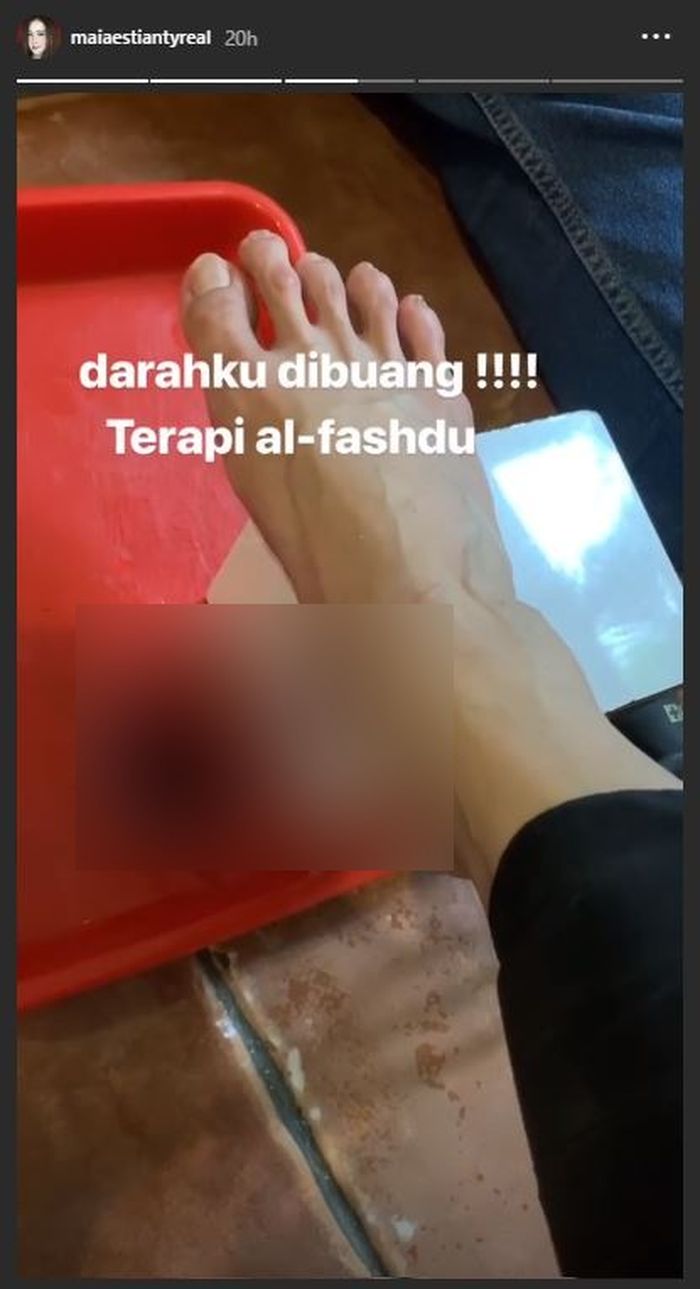 Maia Estianty memperlihatkan cara kerja terapi Al-Fasdhu yang dijalaninya. Maia Estianty harus rela kakinya ditusuk jarum dan darahnya dikeluarkan.