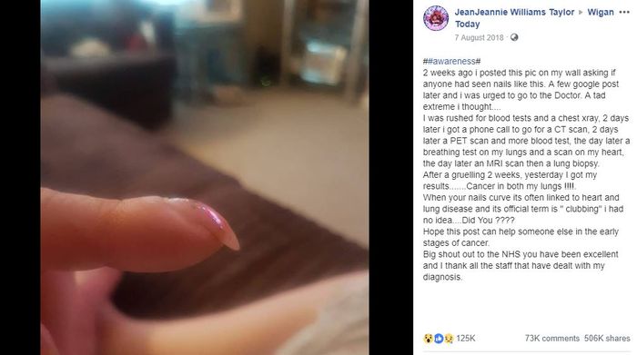Kondisi kuku melengkung ke bawah bisa menjadi gejala kanker paru-paru