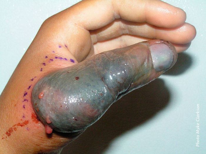Dampak gigitan ular stiletto.