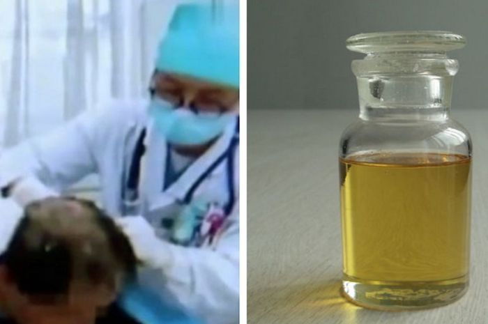 Seorang pria tak sengaja menggunakan pestisida dalam botol yang diletakkan di sebelah botol shampo untuk keramas.