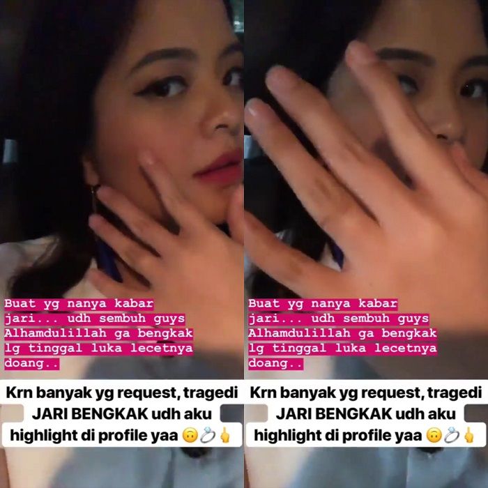 Kondisi terkini jari Tasya Kamila setelah memotong cincin kawin agar bisa terlepas.