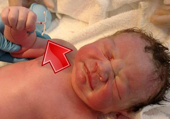 Bayi ini lahir dengan alat KB spiral milik ibunya
