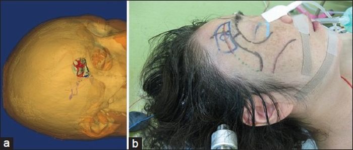 Operasi keyhole surgery supraorbital approach
