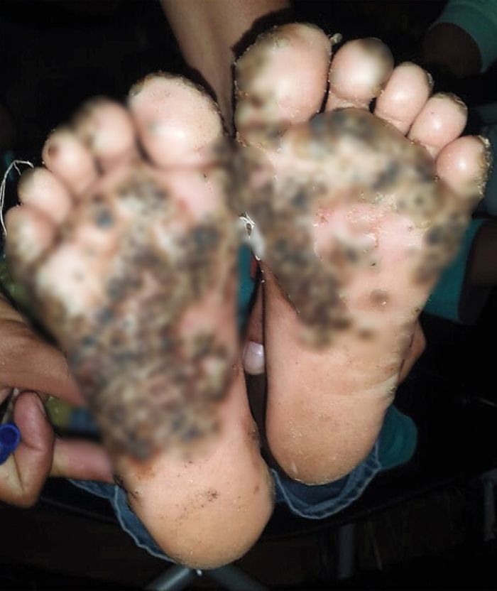 Kaki si gadis yang terkena kutu pasir parasit