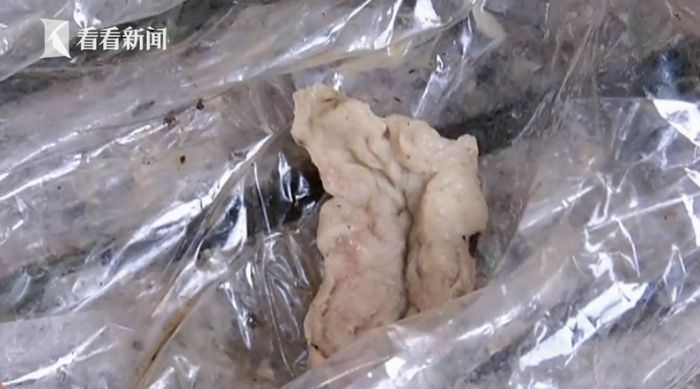 Dia mengeluarkan kapas dari rongga hidungnya.