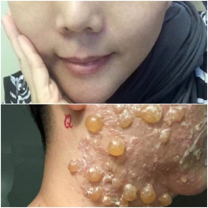 Jalani operasi pengencangan kulit, wajahnya justru melepuh.