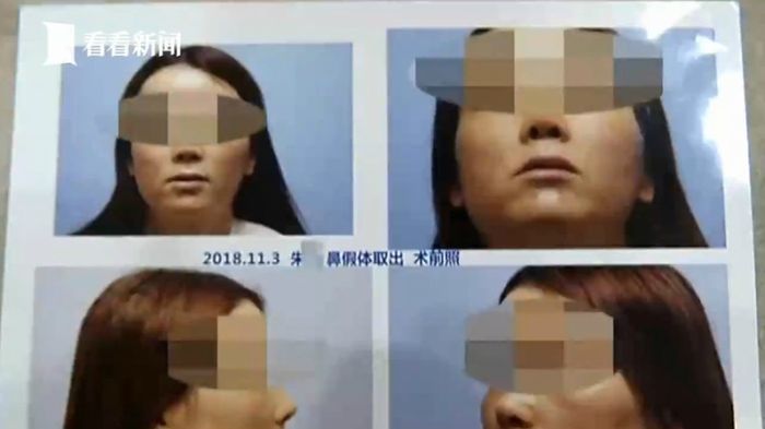 Sebelumnya Zhu melakukan operasi untuk mengubah bentuk hidungnya.