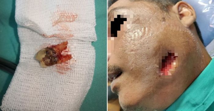 Karena menyepelekan sakit giginya, pria ini justru mengalami kondisi yang semakin parah