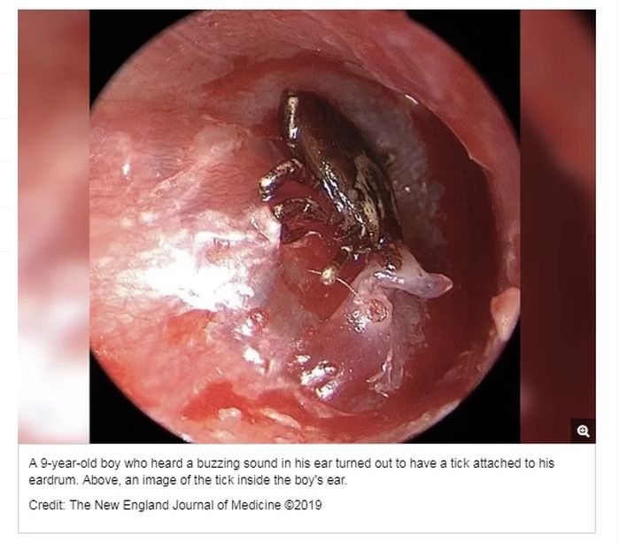 Dengar Suara Berdengung di Telinga, Ternyata Ada Hewan Kecil Ini di
