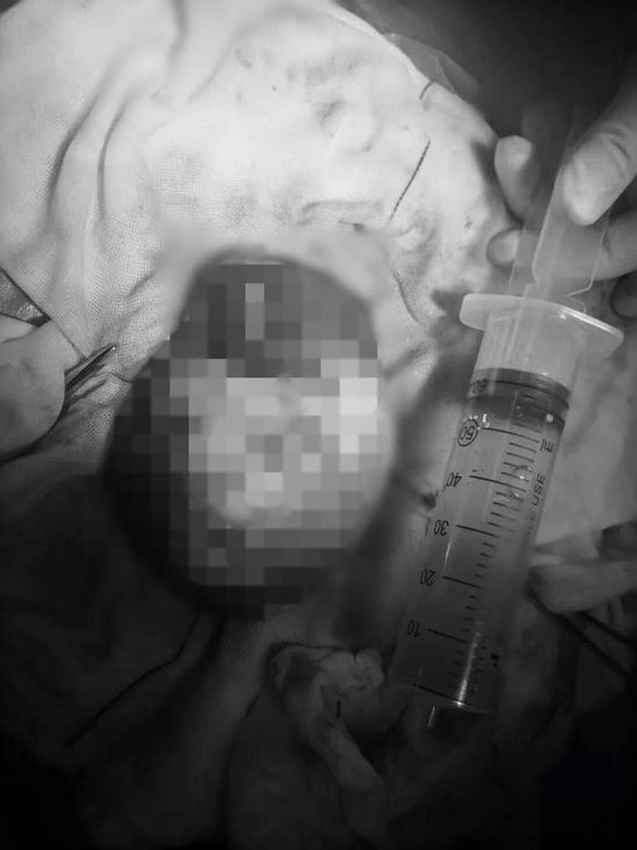Inilah tertaoma yang berhasil dikeluarkan dari perut gadis tersebut.