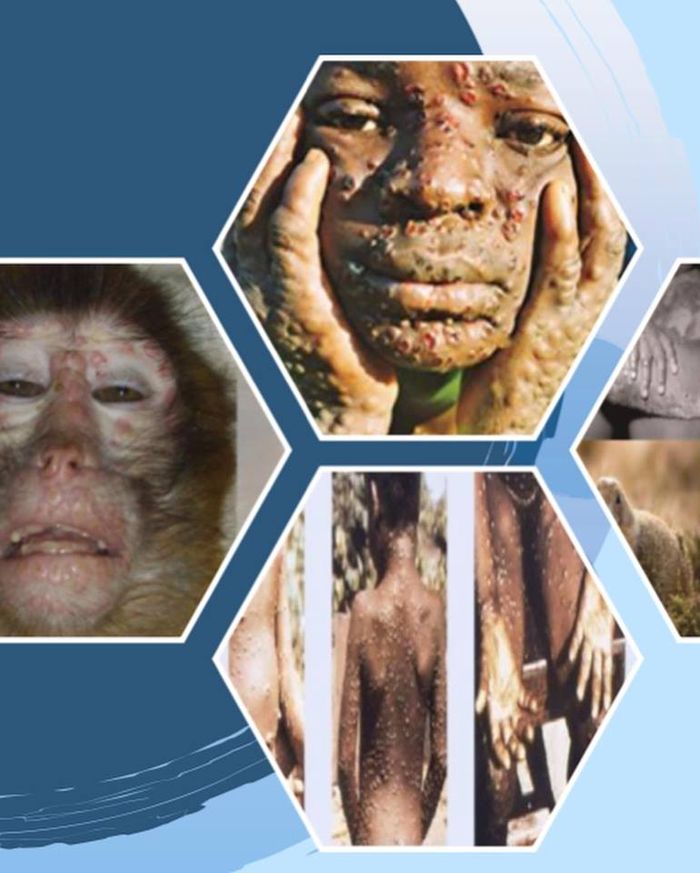 Kondisi manusia dan primata yang terinveksi virus monkeypox