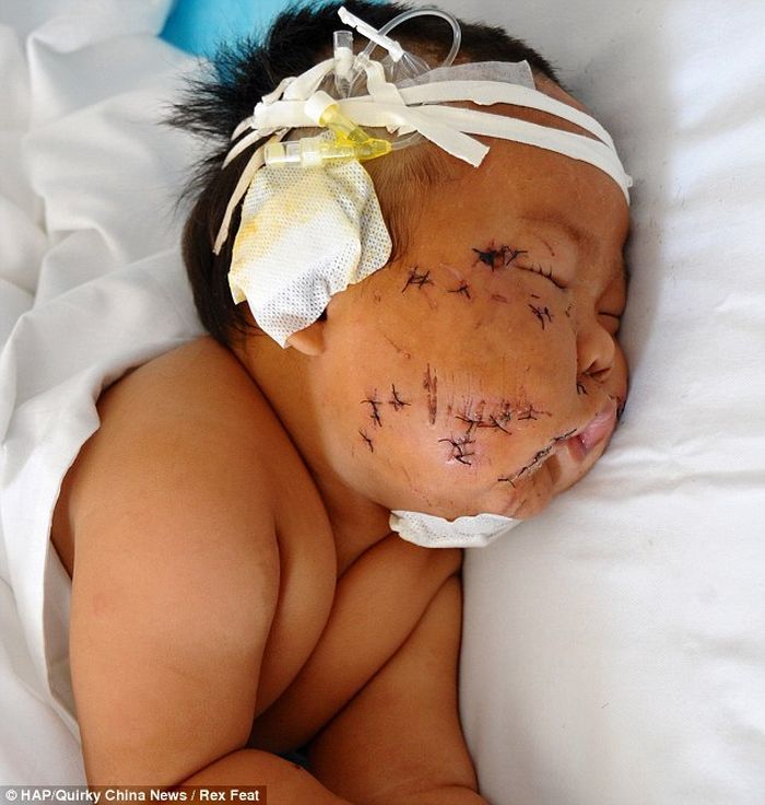 Miris! Bayi 9 Bulan Ditusuk 90 Kali karena Menggigit Puting Ibunya Saat Menyusu
