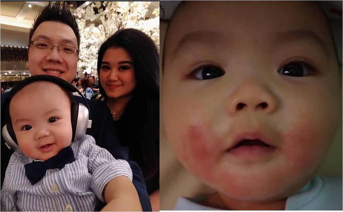 Bayi lucu, Ryuzio saat diajak ke pesta, saat masih sehat dan sepulang dari pesta, pipinya merah terkan dermatitis atopik.