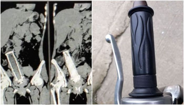 Hilang kesadaran pada saat mabuk, seorang suami tega masukkan handle stang motor dalam rahim istrinya.