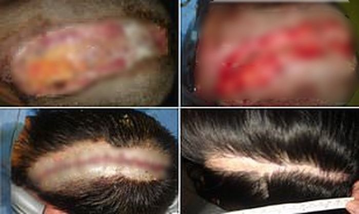 Akibat cat rambut,  wanita ini dapat luka menganga 