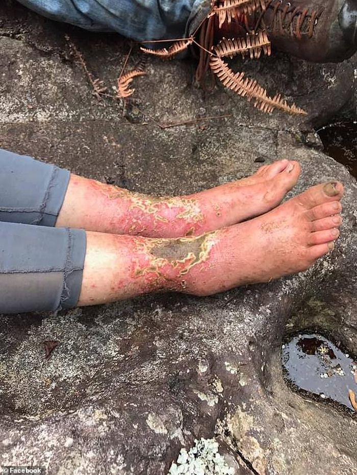 Eller dibawa ke tempat yang aman hanya dengan 'sedikit luka terbakar sinar matahari' dan luka di kakinya.
