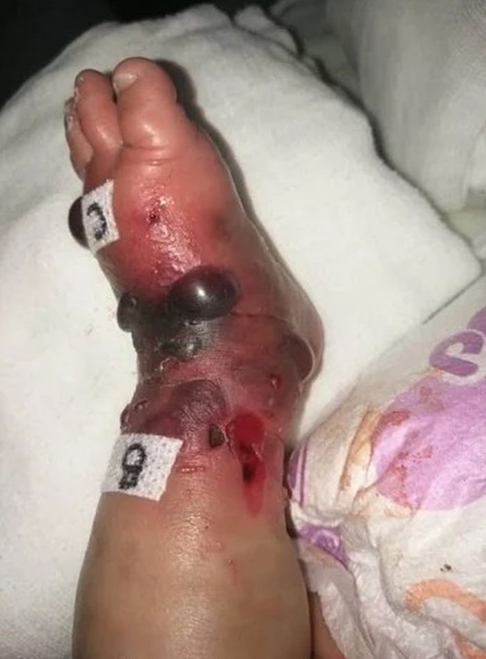 Kaki Zain menjadi bengkak