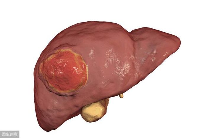 Ilustrasi-Tumor hati.