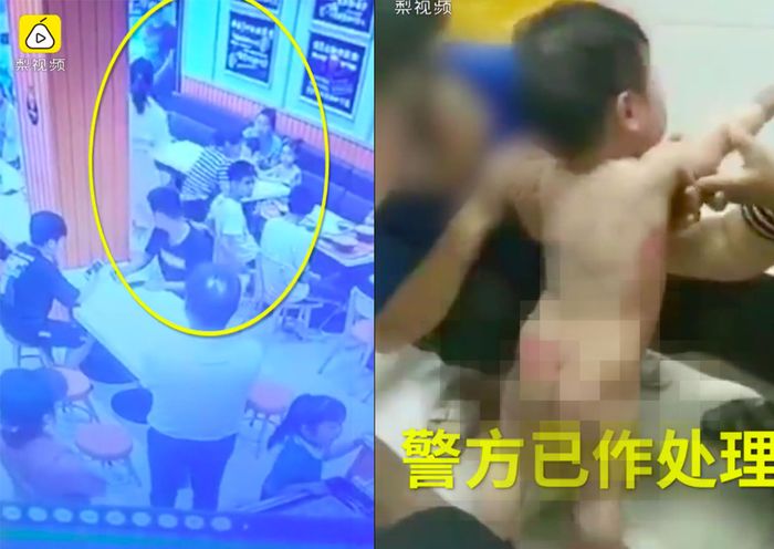 Pelaku melemparkan sup panas ke ibu dan bayi (kiri), bayi 11 bulan itu mengalami luka bakar di punggung dan bokong (kanan)