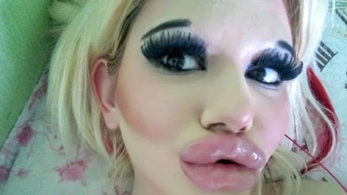 Wajah Andrea Ivanova setelah menjalani 15 kali operasi plastik