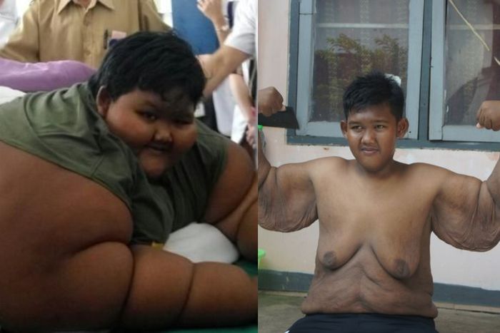 Arya Permana, sebelum dan sesudah menjalani operasi bariatrik.