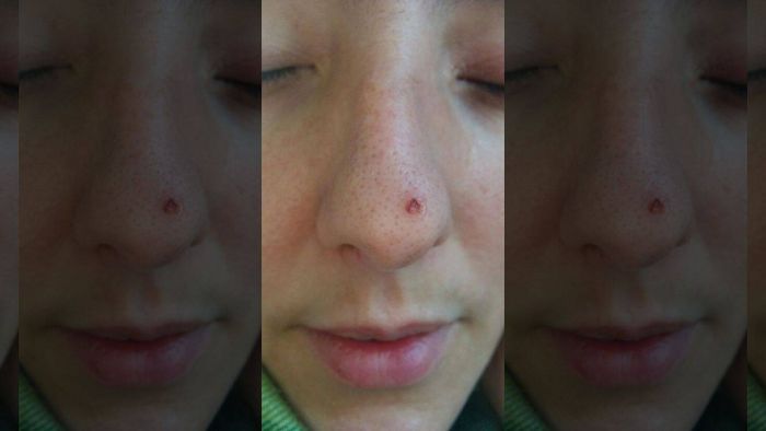Terkena Kanker Kulit, Hidung Perempuan Ini Bolong karena Enggak Pernah Pakai Tabir Surya