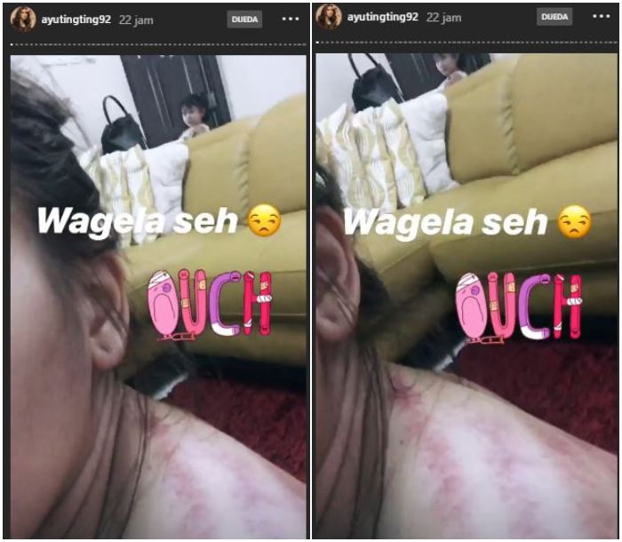 Tubuh Ayu Ting Ting yang penuh dengan kerokan pasca balik pulang dari luar negeri.