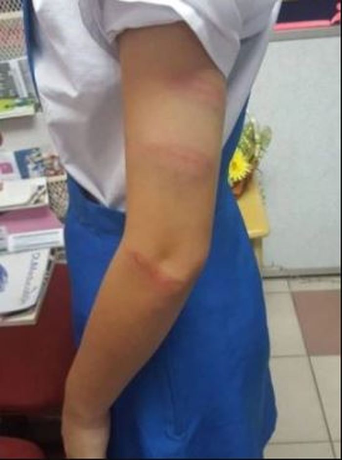 Bekas pukulan pada tubuh seorang siswi