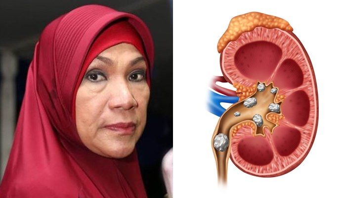 Dorce Gamalam Hidup dengan Penyakit Batu Ginjal: Ternyata Obat Batu Ginjal Ada di Rumah, Salah Satunya Air Cuka