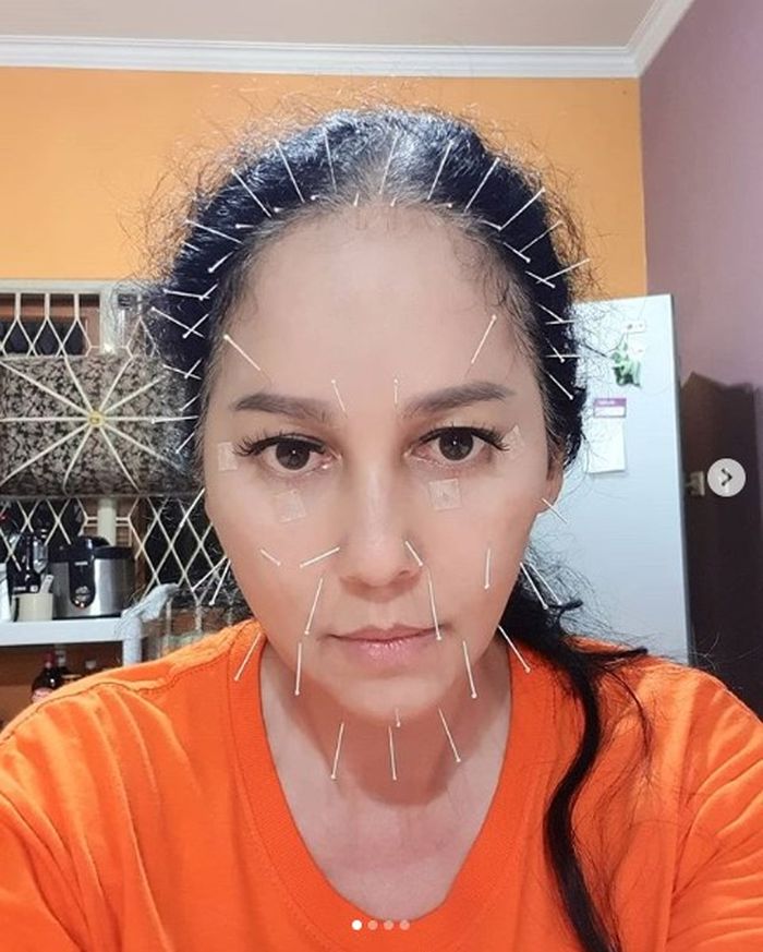 Meriam Bellina yang sedang menjalani akupunktur wajah