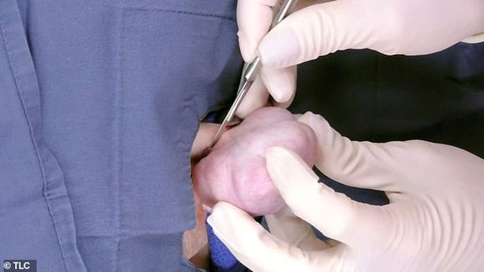 Proses operasi keloid di telinga Jennifer
