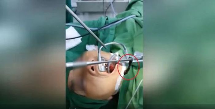 Dokter berhasil mengambil lintah hidup dari tenggorokan wanita itu.