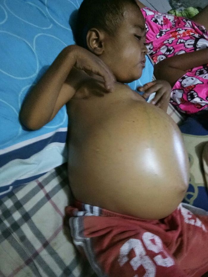 Kondisi Mahfudz saat belum terdiagnosa kanker LCH.