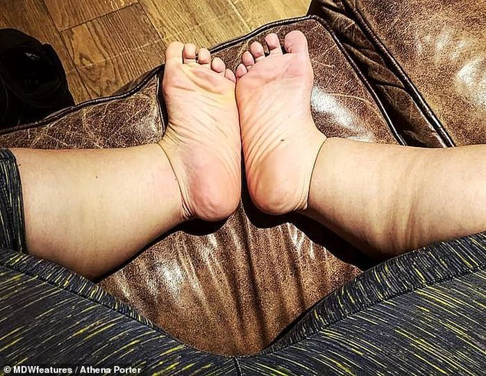 Kaki dan paha Athena Porter yang membengkak karena lipoedema