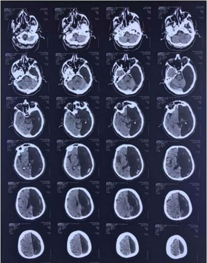 Hasil scan otak pria dengan setengah otaknya.