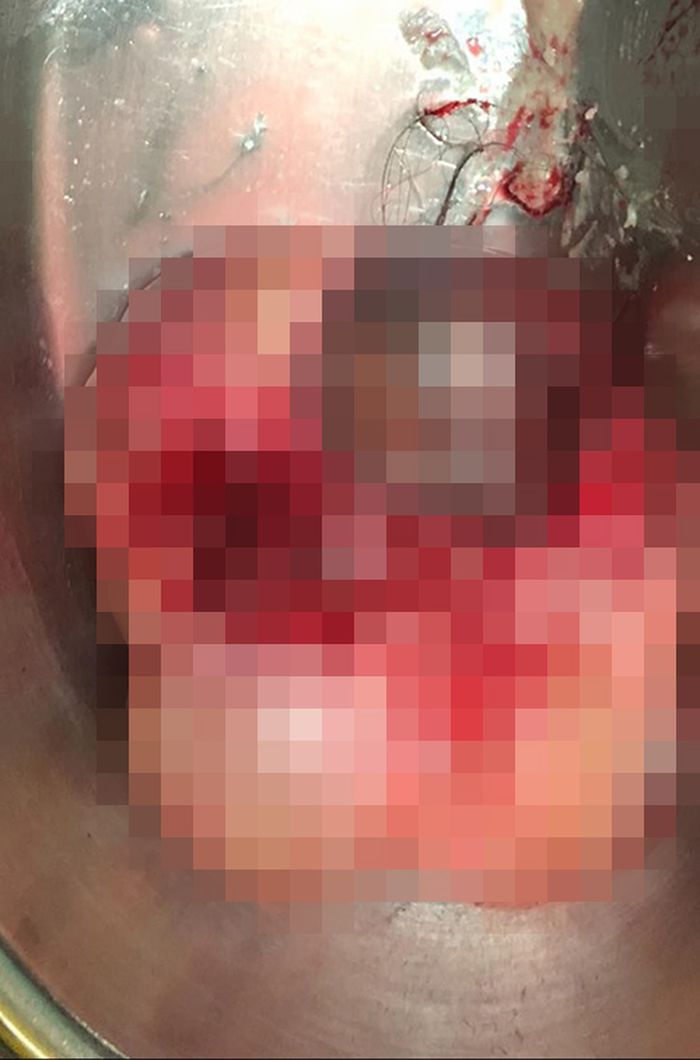 Kista Eyza Zakiey setelah dioperasi