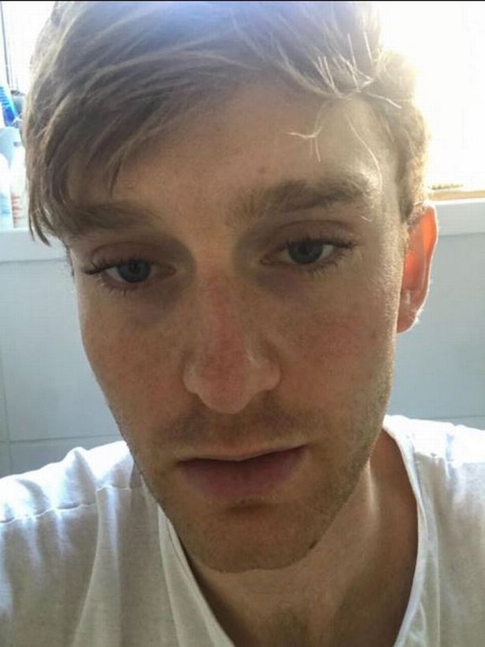 Joe Blackaby (22) kesulitan melakukan kegiatan sederhana