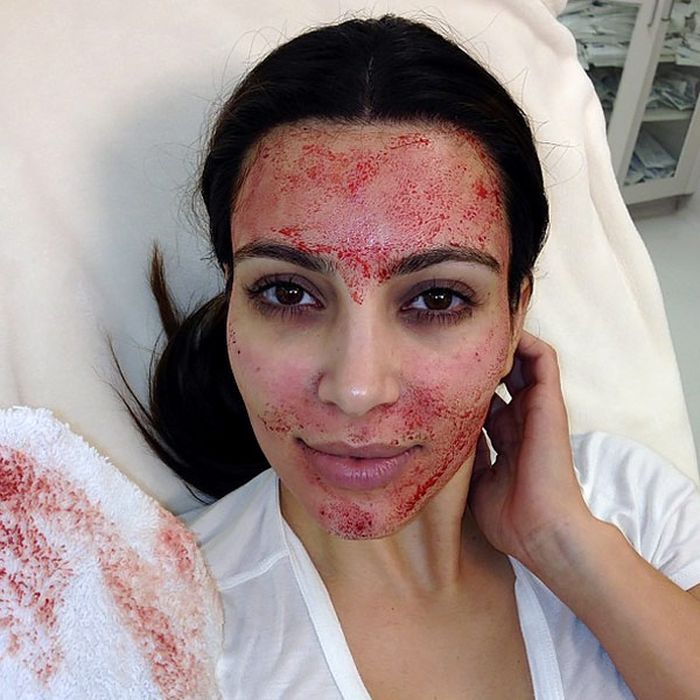 Kim Kardashian melakukan teatment vampire lifting