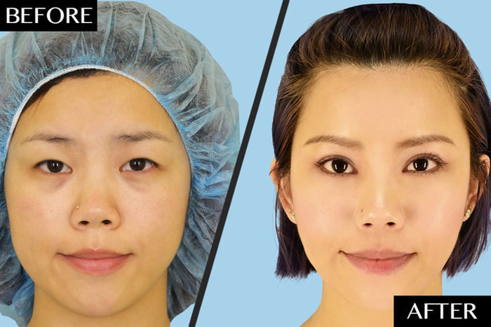 Double Eyelid Surgery